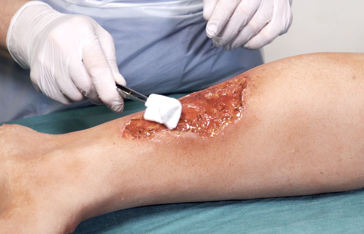 Terveydenhuollon ammattilainen puhdistaa isoa jalkahaavaa.