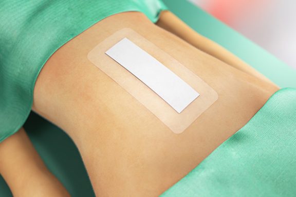 Sorbact-sidos vatsan leikkaushaavan päällä.