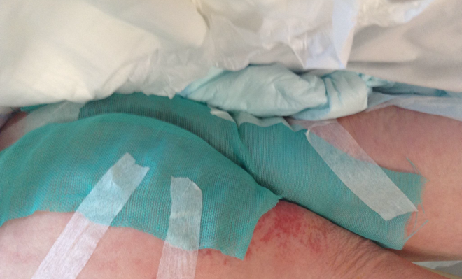 Sorbact Surgical Dressing applied on a patient with fungal infection in skin fold