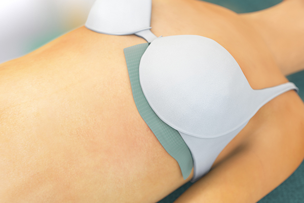 An illustrated torso with sorbact ribbon gauze under a bra.