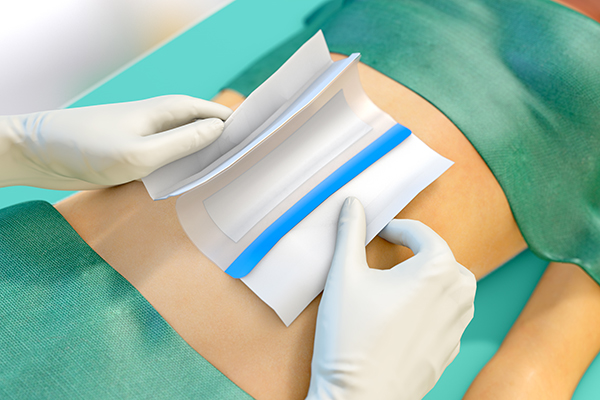Two hand apply the Sorbact surgical dressing on an abdomen.